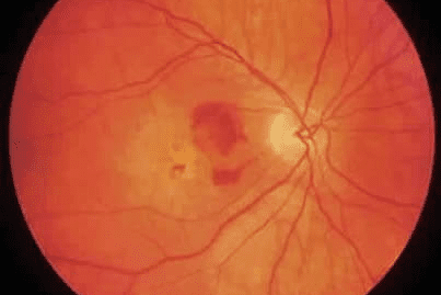 En la DMRE húmeda podemos observar hemorragias del fondo de ojo.