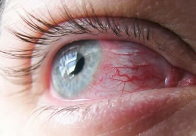 El ojo rojo así como la comezón en el ojo son los síntomas más frecuentes de alergia ocular.